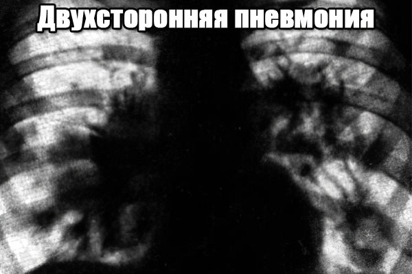 двусторонняя пневмония двусторонняя пневмония