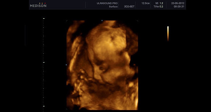 УЗИ на 31 неделе беременности УЗИ на 31 неделе беременности