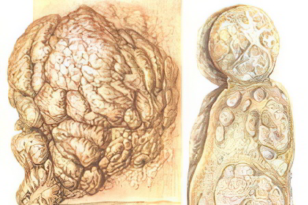 Фиброма Фиброма