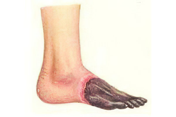 Формы гангрены Формы гангрены