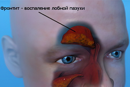 Фронтит что это Фронтит что это