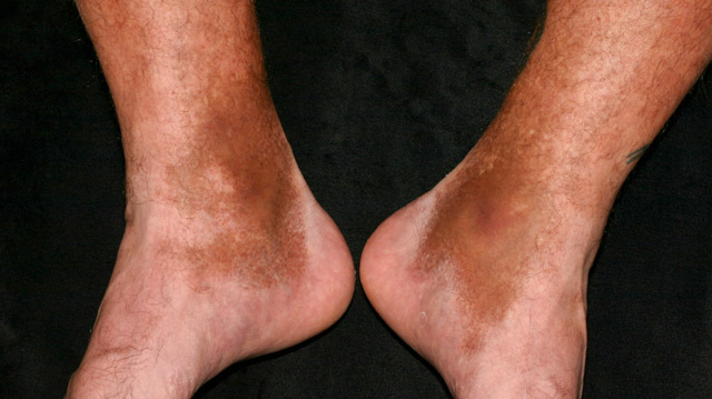 Гемосидероз кожи Гемосидероз кожи