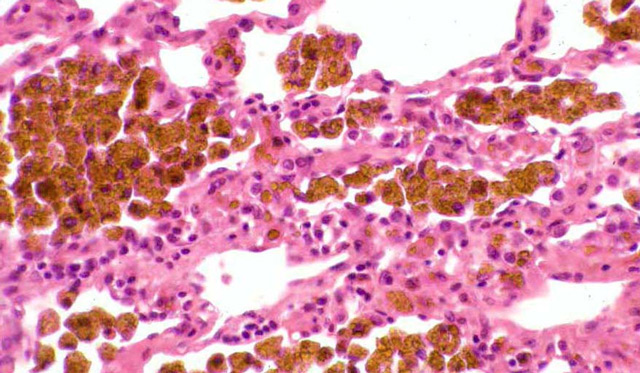 Виды гемосидероза Виды гемосидероза