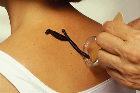 Гирудотерапия Гирудотерапия