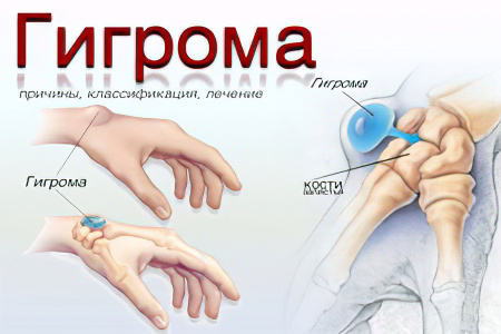 Гигрома – что Гигрома – что