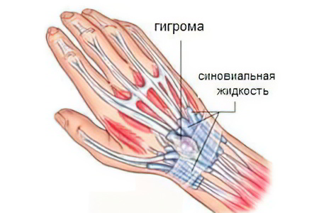 Что такое гигрома запястья Что такое гигрома запястья