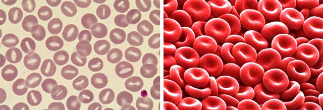 Почему развивается гиперволемия Почему развивается гиперволемия