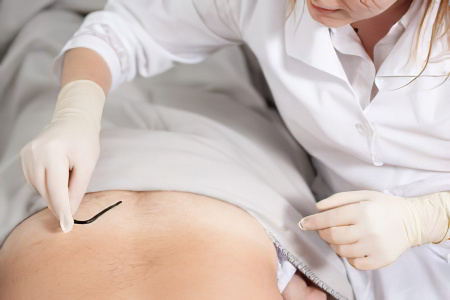 Гирудотерапевт Гирудотерапевт