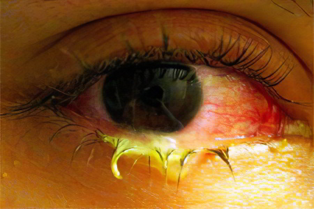 Гноятся глаза у взрослого Гноятся глаза у взрослого