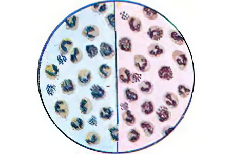 Проблема резистентности гонококков Проблема резистентности гонококков