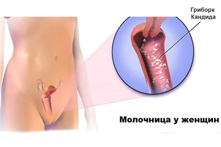 Что такое молочница у женщин Что такое молочница у женщин