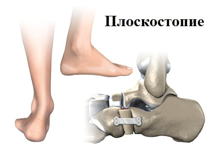 Хирургическая коррекция Хирургическая коррекция