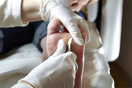 Хирургическое удаление бородавки Хирургическое удаление бородавки