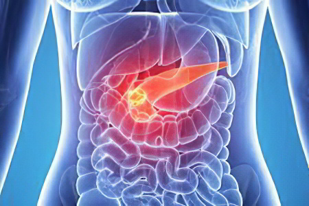 Хронический панкреатит Хронический панкреатит