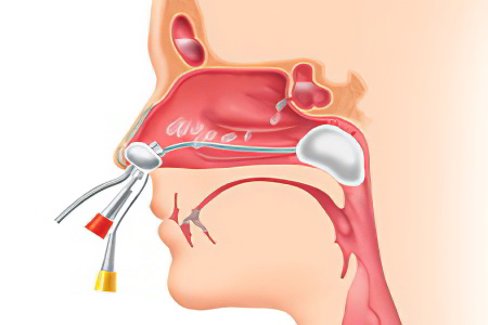 ЯМИК-метод ЯМИК-метод