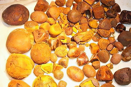 камни в желчном пузыре камни в желчном пузыре