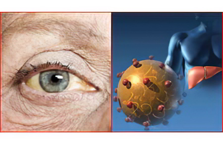 Жёлтые глаза при болезнях печени Жёлтые глаза при болезнях печени