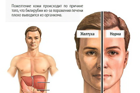Причины возникновения желтухи Причины возникновения желтухи