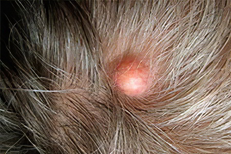 Причины формирования жировика на голове Причины формирования жировика на голове