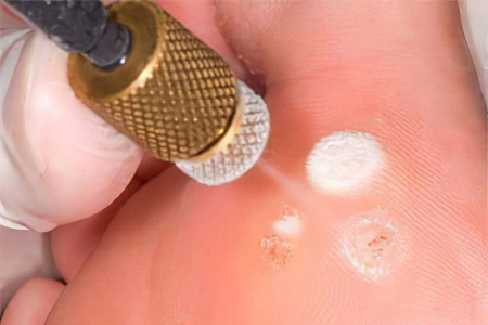 Криодеструкция Криодеструкция