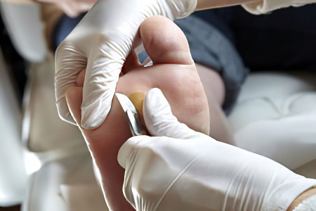 Какой врач занимается удалением мозолей Какой врач занимается удалением мозолей