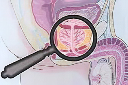 Классификация простатита Классификация простатита