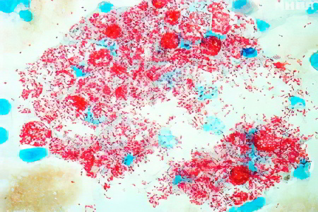 Классификация проказы Классификация проказы