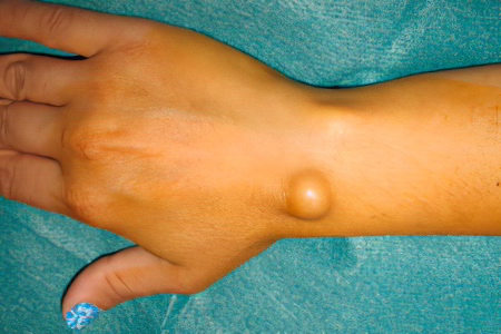 от гигромы консервативными способами от гигромы консервативными способами