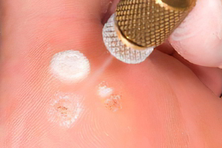 Криодеструкция мозоли со стержнем Криодеструкция мозоли со стержнем