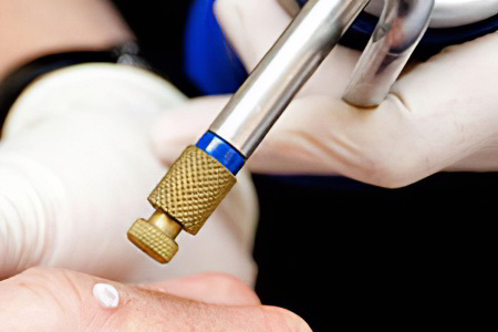 Криодеструкция мозолей Криодеструкция мозолей