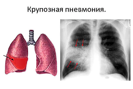 имптомы крупозной формы имптомы крупозной формы