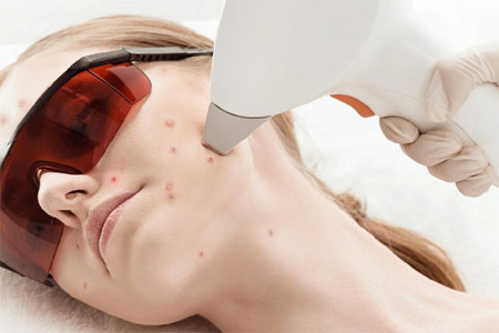 Лазерное лечение акне Лазерное лечение акне