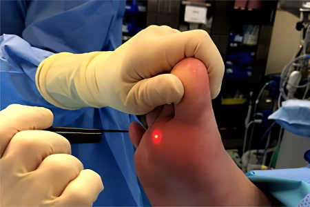 Лазерная коагуляция Лазерная коагуляция