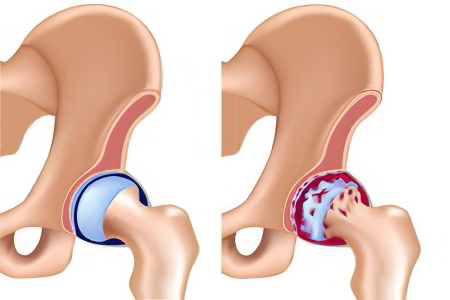 >Остеоартрит, или коксартроз >Остеоартрит, или коксартроз
