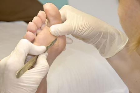 Лечение стержневых мозолей Лечение стержневых мозолей