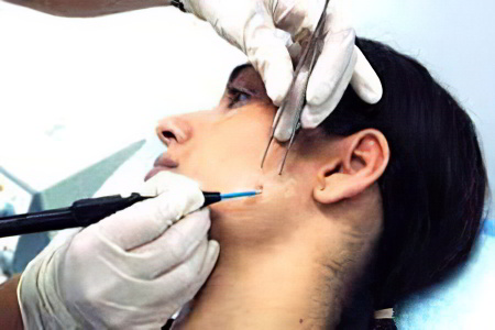 Лечение и удаление атеромы на лице Лечение и удаление атеромы на лице