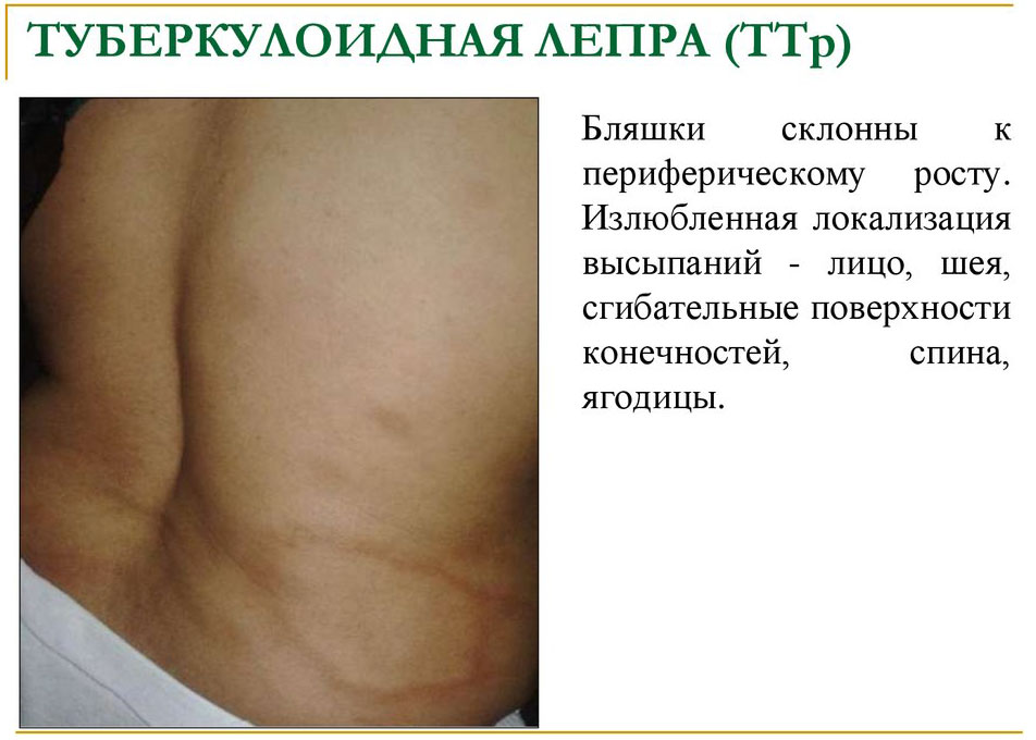 Лепра туберкулоидной формы Лепра туберкулоидной формы