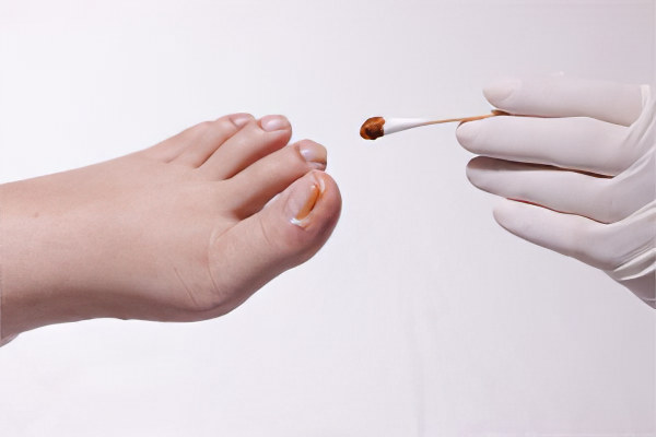 Растворы и мази при вросшем ногте Растворы и мази при вросшем ногте