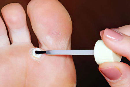 Медикаментозное лечение мозолей Медикаментозное лечение мозолей