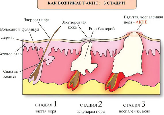 Механизм развития угрей Механизм развития угрей
