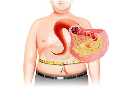 Метаболический синдром Метаболический синдром