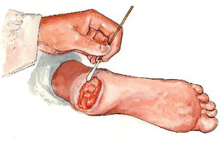 Методы лечения гангрены Методы лечения гангрены
