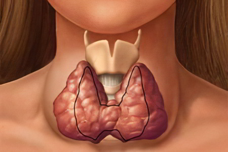 Многоузловой зоб Многоузловой зоб