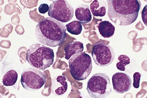 Моноцитопения Моноцитопения