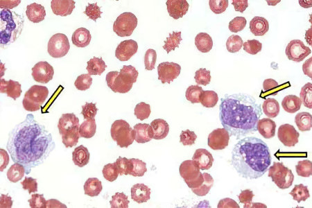 Поноциты повышены Поноциты повышены