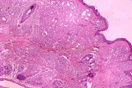 Морфология гемангиом Морфология гемангиом