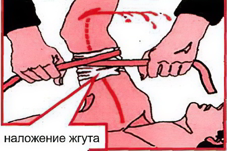 Артериальное кровотечение Артериальное кровотечение