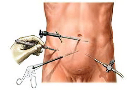 Операция по удалению аппендицита Операция по удалению аппендицита