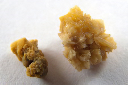 Оксалатные камни Оксалатные камни