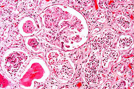 >Осложнений и последствия острого пиелонефрита >Осложнений и последствия острого пиелонефрита